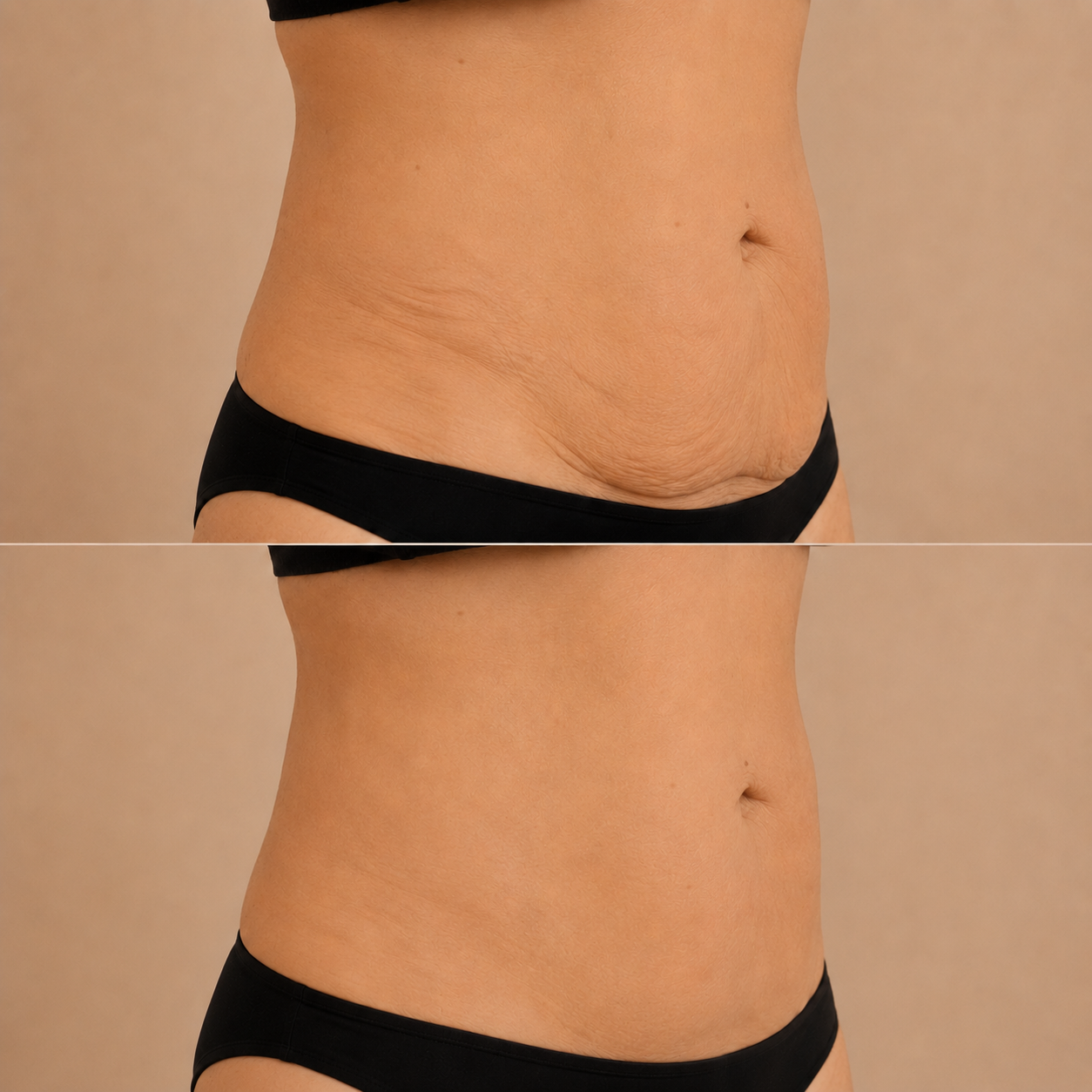 Endolift Före & Efter